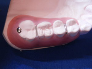 ぺリオ用義歯　揺れのある歯の寿命を延ばすために